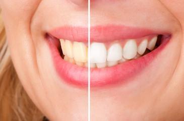 teeth whitening | professional teeth whitening | midland park