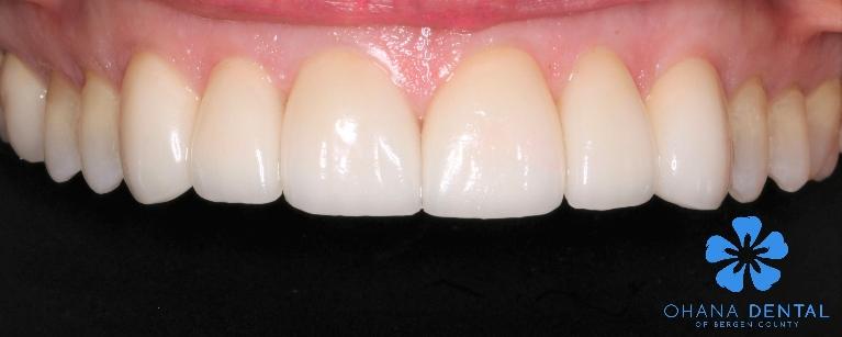 6-veneer-replacement-After-Image