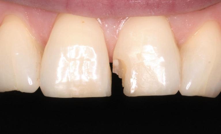 Single-veneer-Before-Image