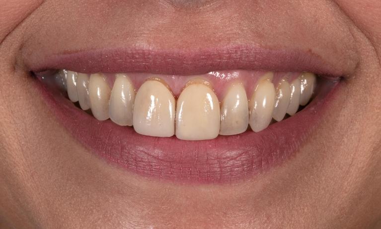 Smile-makeover-Before-Image